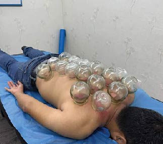 Cupping