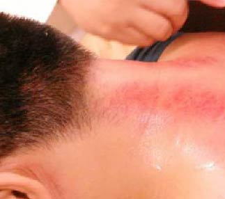 Scraping (Gua Sha)